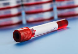 trisomie 21, test sanguin, 